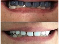 Tratamiento a paciente con prótesis híbrida sobre implante🦷 —> Un caso difícil pero con nosotros encuentras siempre una solución!! • • •  Si necesitas un tratamiento, llámanos o escríbenos: .⬇️⬇️⬇️⬇️. 7 52 04 29  320 459 80 28  Bogotá - Colombia 🇨🇴