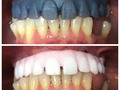 Tratamiento a paciente con prótesis híbrida sobre implante🦷 —> Un caso difícil pero con nosotros encuentras siempre una solución!! • • •  Si necesitas un tratamiento, llámanos o escríbenos: .⬇️⬇️⬇️⬇️. 7 52 04 29  320 459 80 28  Bogotá - Colombia 🇨🇴
