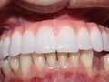 Tratamiento a paciente con prótesis híbrida sobre implante🦷 —> Un caso difícil pero con nosotros encuentras siempre una solución!! • • •  Si necesitas un tratamiento, llámanos o escríbenos: .⬇️⬇️⬇️⬇️. 7 52 04 29  320 459 80 28  Bogotá - Colombia 🇨🇴