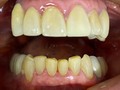 Carillas en disilicato de litio en dientes inferiores para recuperar estructura dental, perdida por envejecimiento de los dientes.  ✔️Mejoramos estética y funcionalidad para darle larga vida a los dientes 🦷😁👏🏻