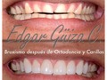 Dr. Edgar Guiza Estetica Dental, Implantes Dentales, Ortdoncia. Pbx: 256 55 66 Bogota. #odontologobogota #carillasderesina #carillasdeporcelana #rehabilitadororal #implantesdentalescolombia #odontologiacolombia.