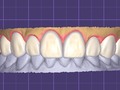 Diseño digital para Carillas Cerámicas.  Dr Edgar Guiza- Rehabilitador Oral.  #diseñodigitaldesonrisa #rehabilitadororalenbogota#implantesdwntalesenbogota#blanqueamientodental#odontologoenbogota#odontologoencolombia