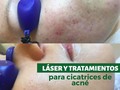 Puedes ver la enorme mejoría después de 3era sesión de aplicación de LÁSER PICOSECOND para Cicatrices y Marcas por lesiones de ACNE.  Puedes realizar contacto conmigo al 0414-528.55.03 Estoy ubicada EDIFICIO LA AGUJA PISO 10 AV. 20 ENTRE CALLES 10 y 11  Lcda. Faysuly S. de Zubillaga Esteticista  #Estética  #DrZubillaga #Esposa  #laserterapia #depilacionlaser  #barquisimeto  #Radio #Dinámica 92.9FM