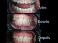 No Seguiste Tus Controles De Ortodoncia Por Mucho Tiempo? 🤔🙄  Lo Más Recomendado Es Retirar Los Brackets... Muchos Pacientes Asisten A La Consulta Sin Ligaduras, Con Brackets Sueltos y Esto No Está Ejerciendo Ningun Tipo De Función 😢😫  Por El Contrario Es Un Foco Para Una Mayor Acumulación De Sarro (El Enemigo Silencioso De Los Dientes)😮😨  Al Retirarlos Eliminamos Todos Los Componentes De Tu Tratamiento, Realizamos Una Limpieza Profunda y Pulido Cuidadoso...   Tus Dientes y Encía Lo Agradecerán😁🦷  #ortodoncia #cuidado #dental #responsable #saludbucal #higiene #encias #sanas #dientes #saludables #providencia #stgochile