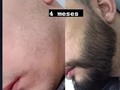 Resultados CLIENTE COMBO BARBA EN TIEMPO RECORD. Encuentralo 👉 @manbarberd ✅