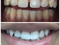 No en todos los casos es posible realizar tratamiento de ortodoncia, hoy realizamos este cierre de diastema con resina, nuestra paciente quedó feliz con el resultado y nosotros estamos felices de que pueda sonreír con tranquilidad #resinas #blanqueamientodental #odontologia #diseñodesonrisa #minimainvasion #sonrisas #dientessanos #dientessaludables #saludoral #aclaramientodental #especialistas #ortodoncia #odontopediatria #colombia