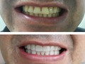 Los lentes cerámicos son una excelente opción para mejorar tu sonrisa!  Solicita tu cita de valoración al 607 40 87 o al 310 397 41 63 para nosotros es un gusto atenderte.  . . . . . . . #elemental #sonrisas #odontologiacolombia #dientesblancos #blanqueamientodental #diseñodesonrisa #diseñodesonrisamedellin #diseñodesonrisacolombia #saludoral #lentesceramicos #medellin #centralmayoristadeantioquia #sonrie