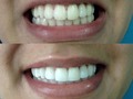 Diseño de sonrisa mínimamente invasivo, para este caso realizamos blanqueamiento dental y bordes en resina estética en cuatro dientes superiores.  Solicita tu cita en el 3103974163