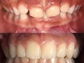 Resultado después de realizar tratamiento primero de ortopedia y luego de ortodoncia, cuando se inicia realizan estos procedimientos en la edad adecuada es posible corregir problemas que más adelante solo se podrían solucionar con cirugía. Solicita tu cita en el 3103974163