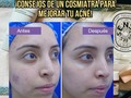 ¡Bye Bye Manchas y acné!🧴🙌🏻  El acné puede aparecer por múltiples razones, entre ellos: ✅Cambios hormonales. ✅Ciertos medicamentos. ✅Usar productos incorrectos o una incorrecta higiene facial. ✅No retirar correctamente el maquillaje (en el caso de quienes lo usan) o dormir con este.  ✅Alergia a productos. ✅No limpiar correctamente tus brochas, no cambiar las fundas de la cama, etc. ✅Alimentación. ✅Estrés. ✅Genética.  Sin embargo, tengo buenas noticias ¡Para todos los casos hay solución! Siempre y cuando acudas a especialistas en el área.  ❤️Guarda esta información y compártela con esa persona que pueda serle muy útil.  👉🏻Disponible consultas online para Venezuela y todo el mundo🌎 ¡Reserva tú cita y empieza a ver cambios favorables en tu piel desde casa!👏🏻 -Para todas las edades- 📧 Información al DM para consultas y asesorías | Contacto de WhatsApp para información +58 412-0839463 / +58 412-5267275 📲