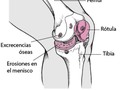 *Qué es la artritis y porque se da⁉️*  La artritis involucra la degradación de las estructuras articulares, particularmente del cartílago. El cartílago normal protege una articulación y permite que esta se mueva de forma suave. El cartílago también absorbe el golpe cuando se ejerce presión sobre la articulación, como sucede cuando se camina.  *😘✍️🗒️🗒️🗒️ Amigos quise comentarles un poquito de lo que sucede o puede suceder cuando ustedes no cuidan ese cuerpo.... Ya sea por excesos o por descuidos....*  *✍️🗒️🗒️🗒️ Cuidemos esa maquinaria maravillosa que nos fue entregada de la mejor forma posible...... El suplementarse diariamente les hará excelentes resultados*