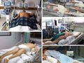 Ventilación mecánica en pacientes con covid 19.  Mucha gente no sabe de qué se trata la ventilación mecánica. Para empezar, NO es una máscara de oxígeno puesta en la boca mientras el paciente está cómodamente acostado. NO. La ventilación invasiva para el Covid-19 es una entubación dolorosa - que por eso se hace bajo anestesia - y consiste en quedarse de 2 a 3 semanas sin moverse, muchas veces boca abajo, con un tubo insertado desde la boca hasta la tráquea y que permite respirar al ritmo de la máquina a la que está conectado. El paciente no puede hablar ni comer, ni hacer nada de manera natural. La molestia y el dolor que se siente, obligan a administrar sedantes y analgésicos para asegurar la tolerancia al tubo durante el tiempo que se necesite la máquina. Es como estar en un coma artificial. A 20 días de éste tratamiento, un paciente joven pierde el 40% de masa muscular, asociado a traumatismos de la boca o de las cuerdas vocales, así como de posibles complicaciones pulmonares o cardiacas. Es por ésta razón que las personas ancianas o ya débiles, no soportan el tratamiento y mueren. Ahora, ¿entendiste lo que es un ventilador mecánico?. . #covid19 #ventilacionmecanica