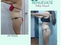 Los resultados hablan por si solos. . . . . . #esteticarenuevate #esteticamente #esteticaprofesional #estéticacorporal #reduccion #reducciondegrasa #reducciondemedidas #mejorcuerpo #cuerpodelgado #mujerbella #bellezaysalud #belleza #bellezaresponsable #esteticista #lamejorestetica #pereira #pereiracapitaldeleje #risaralda #colombia #masajereductivo #masajesdescontracturantes #levantamientodegluteos #masajerelajante
