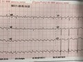 Masculino de 61 años quien consulta por ortopnea y palpitaciones, sin antecedentes de HTA,DM o isquemias.