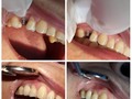 corona metal cerámica diente #15 paciente feliz con sus resultados sede la arboleda #soledad #barranquilla #santamarta #cienagamagdalena #monteria #lifesmilesedearboleda #arboleda #plazadelsol