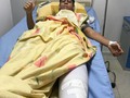 Mi gente lamento informarle que ayer sufrí un accidente jugando fútbol, fractura tibia frontal. Ruego a Dios pronta recuperación, gracias por sus oraciones.