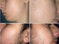 Resultados CLIENTE COMBO BARBA EN TIEMPO RECORD.  1 minoxidil + 1 dermaroller $59 mil  3 minoxidil + 1 dermaroller $105 mil  El dermaroller va a abrir los poros para que el minoxidil tenga una mejor absorción y los resultados se puedan ver mas rapidos