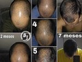 COMBO CRECIMIENTO EN TIEMPO RECORD.  Dermaroller + Minoxidil  Disponible COLOMBIA y MEXICO