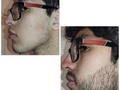 Resultados CLIENTE COMBO BARBA EN TIEMPO RECORD. 4 meses