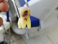 Casito de hoy 😥 El daño que hace el Cálculo Dental y la falta de uso de hilo dental! #Dentistry #Exodoncia #Dentist PD: Paciente no quiso salvarlo 🤷‍♂️