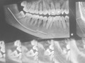 Un buen Dx previene complicaciones en las cirugias! Ahora con toda seguridad podemos extraer los 3eros molares inferiores. #AmoMiCarrera #Cirugia3erosMolares