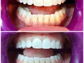 Blanqueamiento en consultorio   Si deseas disminuir tonos en tus dientes @osonrisa es la mejor opción   Recuerda que el blanqueamiento es el último paso de una sonrisa y una boca saludable   Agenda tu cita con nosotros para que estés al día con tu salud bucal   #odontologia #odontologo #saludbucal #ortodoncia #endodoncia #protesisdental #cirugiabucal #limpiezabucal #blanqueamiento #implantes #diseñodesonrisa