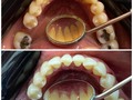 Cálculo dental   El cálculo dental es la calcificación del la masilla (restos de alimentos) que no es eliminado de manera efectiva tras el cepillado   Porque se convierte en piedra? Esto sucede por el calcio presente en la saliva, justo debajo de la lengua tenemos unas de las glándulas salivales mayores, y esto hace que muchas veces tengamos cálculo en la parte de atrás de los dientes inferiores   Es importante acudir al Odontólogo para asegurar la correcta remoción del mismo, ya que esté puede causar daños en los tejidos de inserción de los dientes y podemos sufrir de movilidad o pérdida de piezas dentales   Así que ya sabes! Pide cita con nosotros @osonrisa para ayudarte a remover la placa y el cálculo de tus dientes y así puedas disfrutar de una sonrisa sana   Pide tu cita 📞 Te esperamos 😷  #odontologia  #odontologo  #limpiezadental  #ortodoncia  #cirugiabucal #diseñodesonrisa  #protesisdental  #saludbucal #ortodonciainvisible