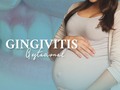 ¿Gingivitis durante el embarazo?🤰🏻 ¡Si es posible!   La gingivitis es una enfermedad periodontal que está causada por la acumulación de placa bacteriana entre los dientes🦠  La causa principal de la gingivitis gestacional es producida a consecuencia de una gingivitis no controlada antes del embarazo.  🤰🏻Durante el embarazo las mujeres pasan por muchos cambios hormonales, lo que a su vez proporciona mayor facilidad a la hora de desarrollar inflamación y sensibilidad en dientes y encías debido a que se vuelven más vulnerables a las bacterias🦷  #gingivitis #gingivitisgestacional #gingivitisproblems #ortodoncia #diseñodesonrisa #blanqueamientodental #odontólogos #caracas #colinasdebellomonte #limpiezadental