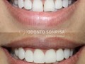 ¿QUÉ ES EL DIASTEMA?  Es el espacio que existe entre dos piezas dentales, frecuentemente en los incisivos superiores centrales, sin embargo, puede estar presente entre cualquier par de dientes o muelas   🦷 El diastema puede deberse a: • Falta de una pieza dental • Dientes pequeños • Malposición de los dientes    ☑️ Los tratamientos para corregir un diastema constan de:  • Uso de ortodoncia • Carillas dentales   En este caso clínico nuestro paciente optó por colocarse carillas dentales ya que era candidato para dicho procedimiento Logrando como resultado final una sonrisa más estética y armónica😄  ¿Qué te parecen estos resultados?   #diastema #carillasdentales #odontologiaestetica #esteticadental #diastemaclosure #diseñodesonrisa #carillasderesina #carillasdeporcelana #venezuela #odontologiapreventiva #odontologiaespecializada #caracas #colinasdebellomonte #clinicadental #odontosonrisa