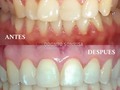 Resultados de un excelente trabajo post ortodoncia😄  En este caso podemos observar como nuestra paciente antes del tratamiento presentaba apiñamiento superior e inferior, mordida cruzada de un diente y diversas rotaciones dentales   Luego de finalizado su tratamiento de ortodoncia, se observan grandes cambios tanto a nivel dentario, funcional y esté🙌🏻  Disponemos de planes de financiamiento en cómodas cuotas para tu tratamiento con ortodoncia tradicional (metálica), invisible e invisaling 🦷💙  Contáctanos para mayor información al: 📲 (0412) 6299571
