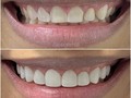 Diseño de 10 carillas en resina SIN desgaste dental🦷  Con esto logramos a nivel estético cambiar la forma, el color y la textura sin producir ningún tipo de daño o desgaste dental  ¿Deseas mayor información? Déjanos saber en un comentario y te contactáremos💙  Estamos ubicados en 📍 Colinas de Bello Monte, subiendo por la Av. Caurimare frente al IUTIRLA  🕚 Atendemos previa cita de Lunes a Viernes de 09:00am a 02:00pm  #diseñodesonrisa #saludbucal #carillas #resina #odontologo #venezuela #clinicaodontológica #caracas #colinasdebellomonte #carillasdentales #resina #esteticadental #carillasderesina