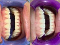 Antes y después: aclaramiento dental🦷💙  ¿Te gustaría tener una sonrisa tan radiante como la de nuestra paciente? En este caso realizamos 2 sesiones de aclaramiento dental en nuestro consultorio para obtener este increíble resultado🙌🏻  Te esperamos en nuestro consultorio @osonrisa para que luzcas una sonrisa mucha más brillante😀  ¡Agenda tu cita ahora mismo! Contáctanos al 📱 (0412) 629 9571  Estamos ubicados en: 📍Colinas de Bello Monte, Av. Caurimare frente al IUTIRLA . . #aclaramientodental #blanqueamientodental #sonrisaradiante #caracas #odontologiaestetica #odontosonrisa #venezuela #odontologocaracas