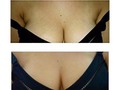 Camuflado de estrias con tatuaje, manejamos pigmentos iden al tono de la piel, todos los tonalidades de piel, el color es definitivo o permanente, solo aqui en @steticamuflash citas al whatsapp +573014512474