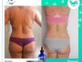 Hola!! Te invito a que conozcas acerca de nuestro Tratamiento 💯 % natural rapido y efectivo,sin efecto rebote,pierde de 10 a 12 kilos de grasa localizada, elimina celulitis y reduce estrias 👌 #tc4premiumoficial las #lipogotas más efectivas del mercado.  Escribeme al whatsapp: +573193813036 y pregunta todo acerca de nuestro tratamiento 👍