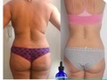 Tratamiento 💯 % natural rapido y efectivo,sin efecto rebote,pierde de 10 a 12 kilos de grasa localizada, elimina celulitis y reduce estrias 👌 #tc4premiumoficial las #lipogotas más efectivas del mercado.  Escribeme al whatsapp: +573193813036 y pregunta todo acerca de nuestro tratamiento 👍