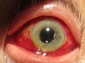 Si te llaman para visitar a una mujer de 62 años que está en urgencias porque el personal de enfermería ha notado la siguiente anomalía en su ojo. Es paciente con antecedentes de fibrilación auricular paroxística y artritis reumatoide. La dama se queja solamente de un pequeño dolor en el ojo. ¿Cuál de sus medicamentos es la causa probable de la lesión?  A. Aspirina B.  Amiodaron C. Acido fólico D. Metotrexato