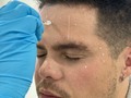¿Te pondrías Botox?